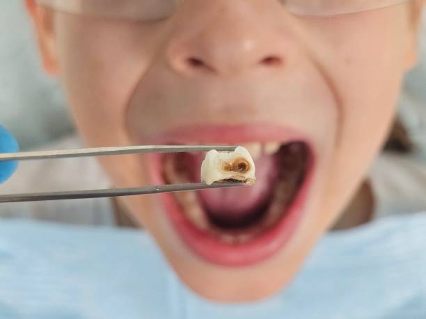 Best Emergency Broken Tooth Repair in Brady, TX